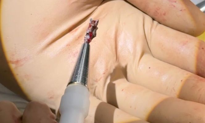 El extractor magnético que extrajo la metralla del corazón de Serhiy.