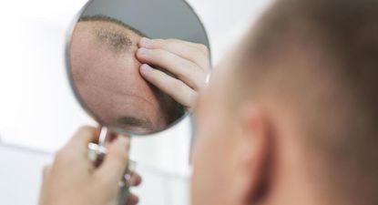 un medicamento para la artritis logro recuperar hasta el 100% del cabello en pacientes con alopecia severa