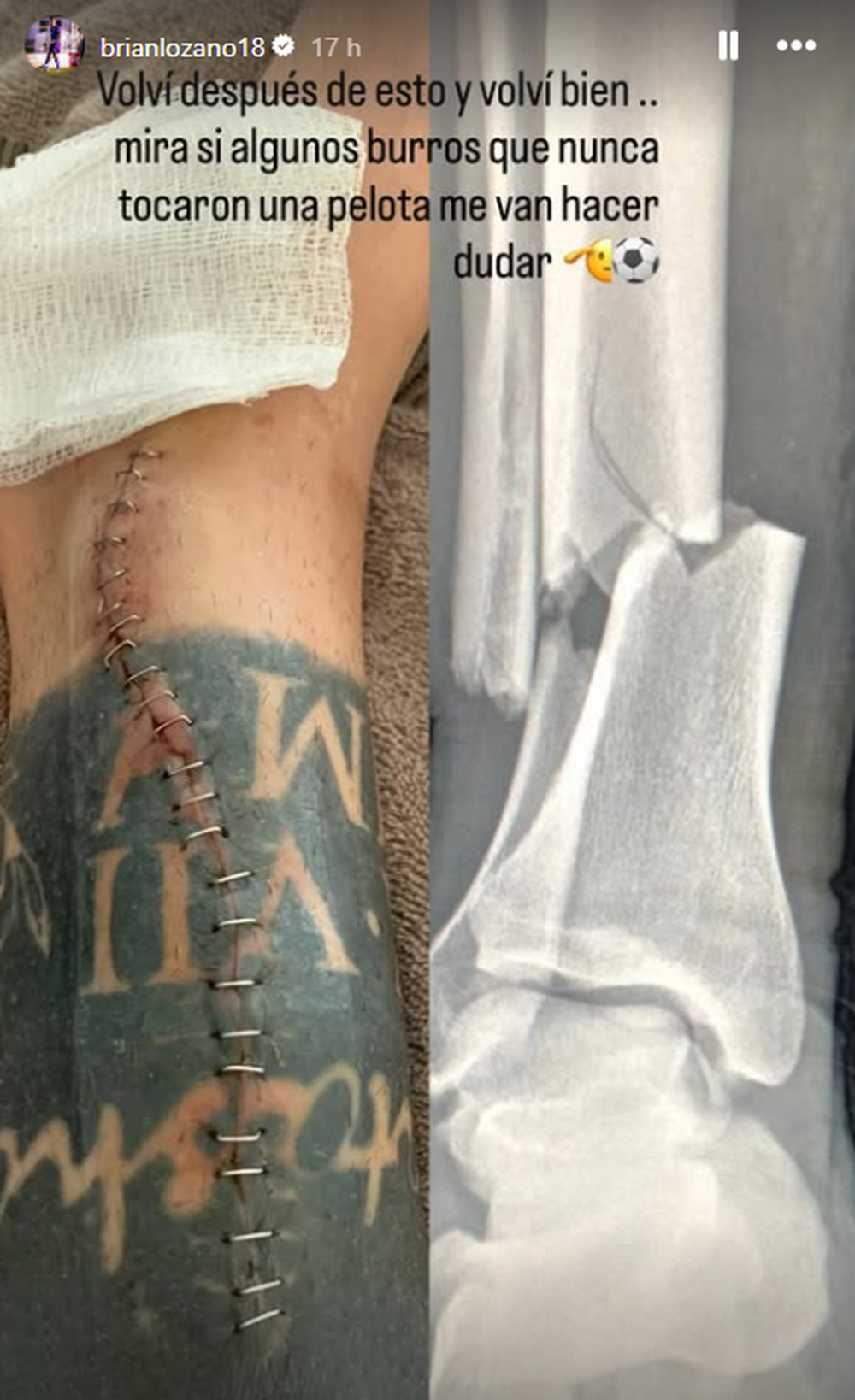El posteo de Brian Lozano con la cicatriz de su lesión