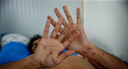 el gobierno de milei activo el protocolo de emergencia ante sintomas de viruela simica en tripulante de un buque proveniente de brasil