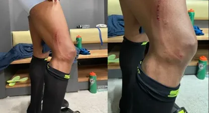 Así quedó la pierna de Estrada