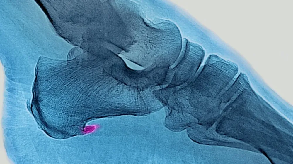Para tratar de minimizar el dolor es posible que el cuerpo modifique su forma de caminar de una manera inconsciente, lo que puede ocasionar problemas en otras zonas del pie, la rodilla y la cadera.