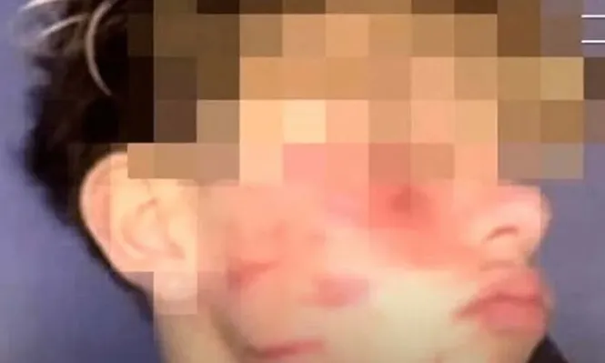 Italia multa a Tik Tok con 10 millones de euros por el reto de la cicatriz francesa.