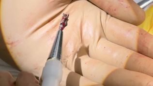 El extractor magnético que extrajo la metralla del corazón de Serhiy.