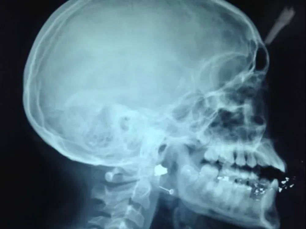 Una cada 10.000 consultas es por un herido de bala grave.