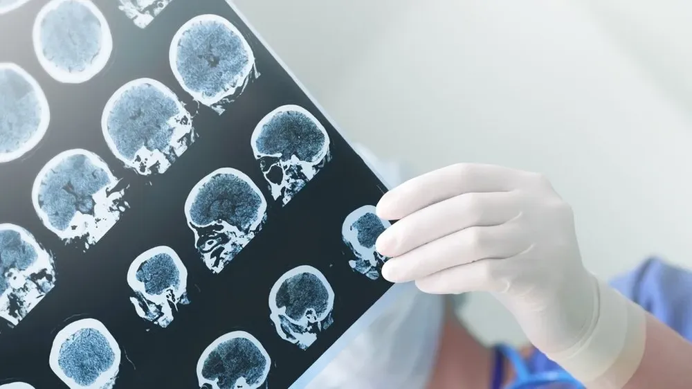 Los científicos usaron imágenes que permiten ver actividad y no solo anatomía