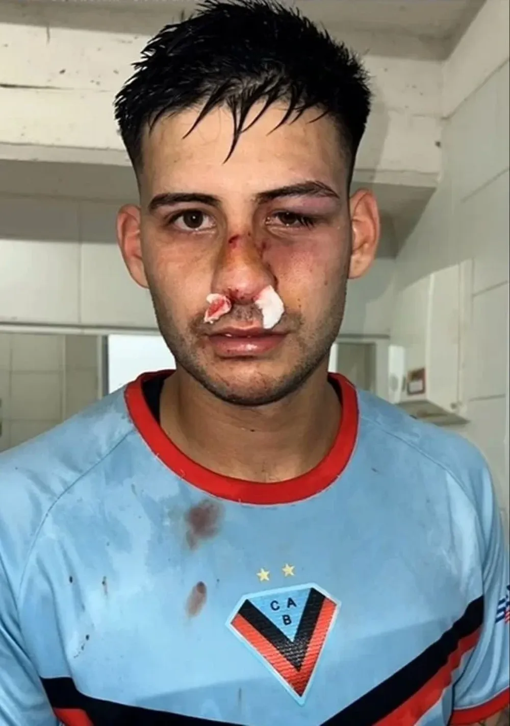 La cara de Juan Pacchini quedó de esta manera luego de recibir una patada