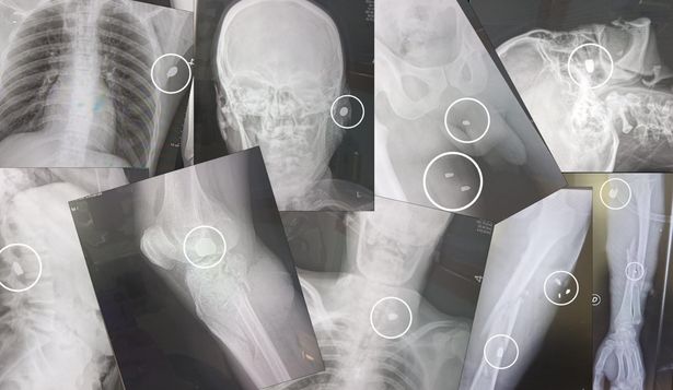 Radiografías de heridos de bala ingresados al hospital del Cerro