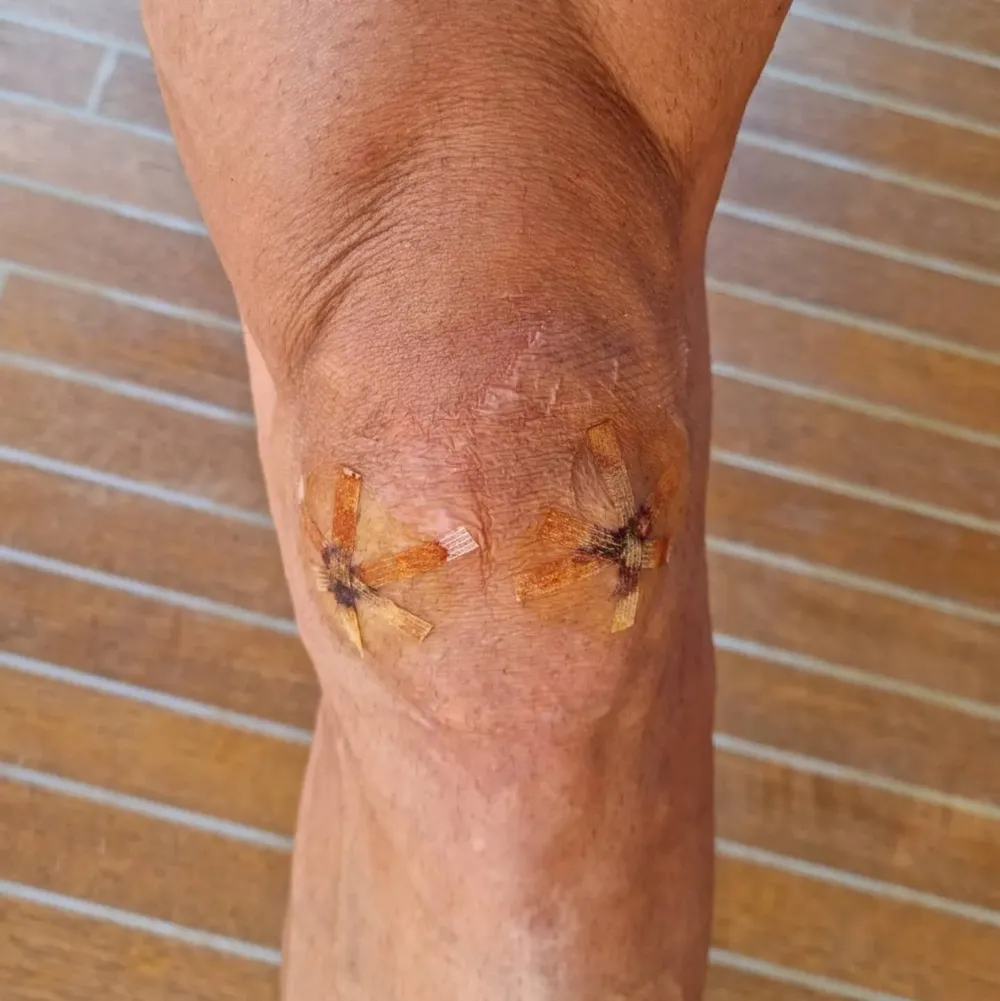 Así estaba la rodilla de Zlatan hace tres meses