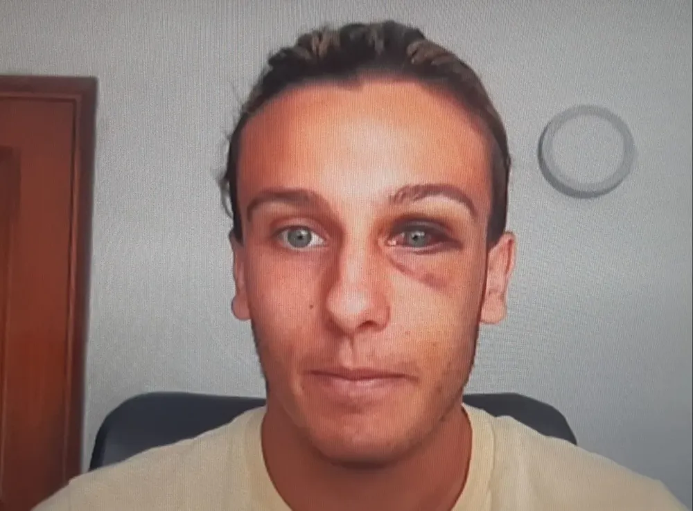 Agustín Canobbio habló de cómo vivió los días posteriores a la cuádruple fractura en su rostro ante Danubio el sábado de la semana pasada en Jardines del Hipódromo