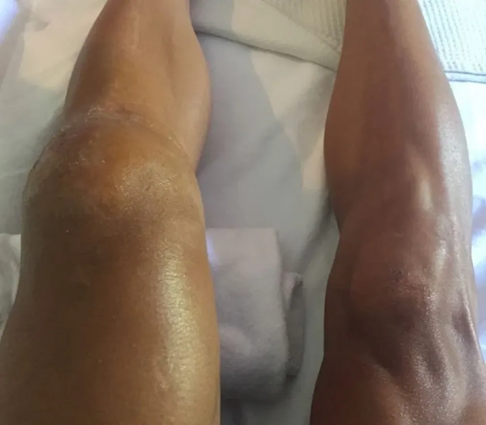 La rodilla de Gilbert