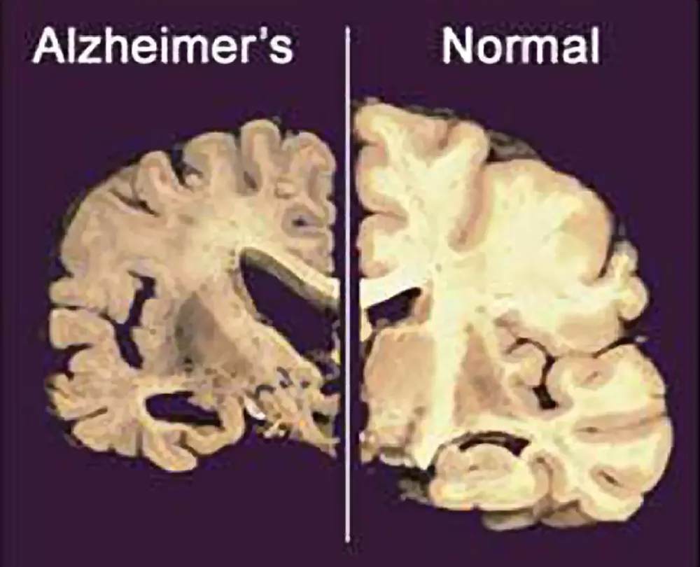 A la izquierda, una sección del cerebro afectado por Alzheimer avanzado, visiblemente más deteriorado que un cerebro normal