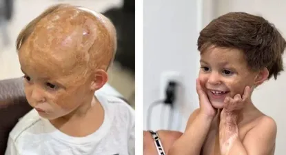 Lorenzo, uno de los niños que recibió una prótesis capilar.