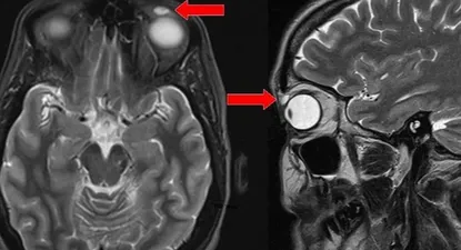 Una resonancia magnética mostró el quiste sobre el ojo de la mujer.