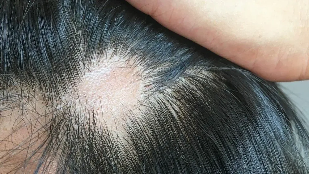 La caída del cabello causada por el coronavirus suele ser temporal.