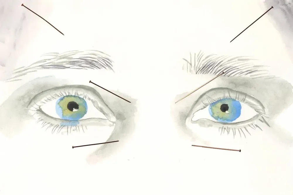 Las agujas se enfocan en la tensión y el estrés físico y mental y promueven la buena circulación
