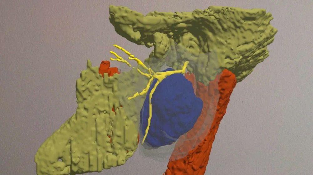 El holograma: la sección azul es el tumor con el nervio facial amarillo que lo atraviesa.