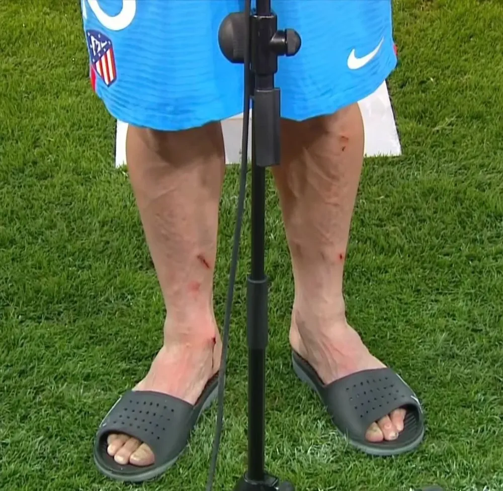 Así quedaron las piernas de Héctor Herrera tras el partido de Atlético en Old Trafford