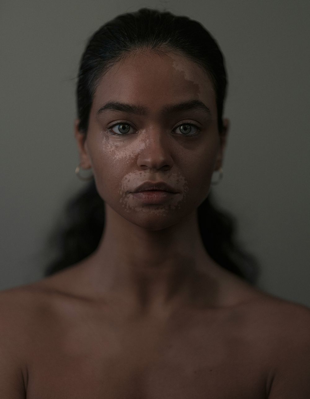 El vitíligo afecta entre el 0,5% y el 1% de la población mundial.