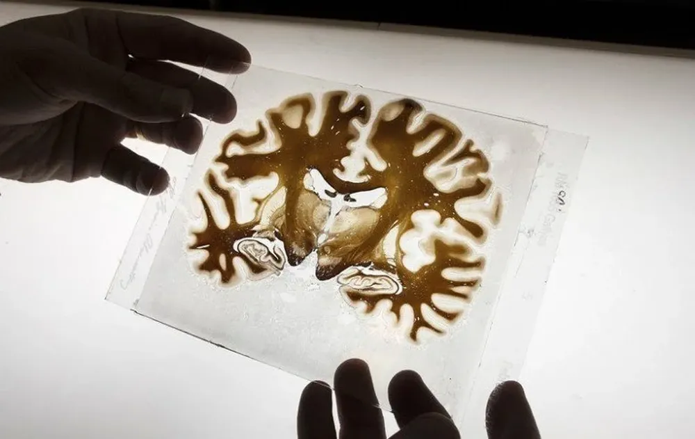 Las respuestas de los adultos mayores con problemas de colesterol a tests cognitivos son en promedio 3 segundos más lentas