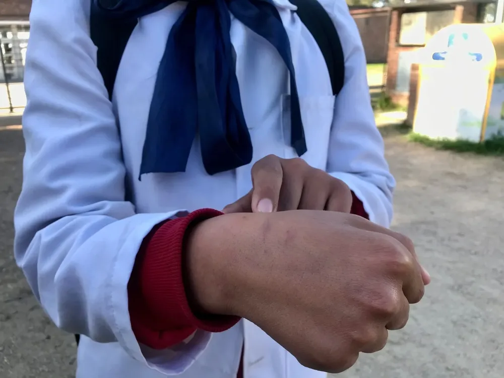 Las marcas en niño que se lesionó en Barros Blancos