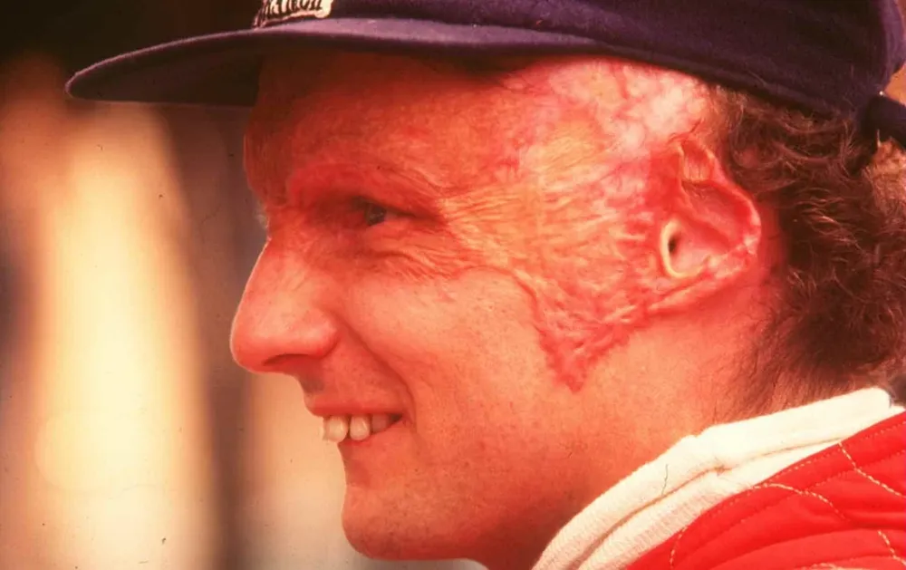 Niki Lauda luego del accidente de 1976