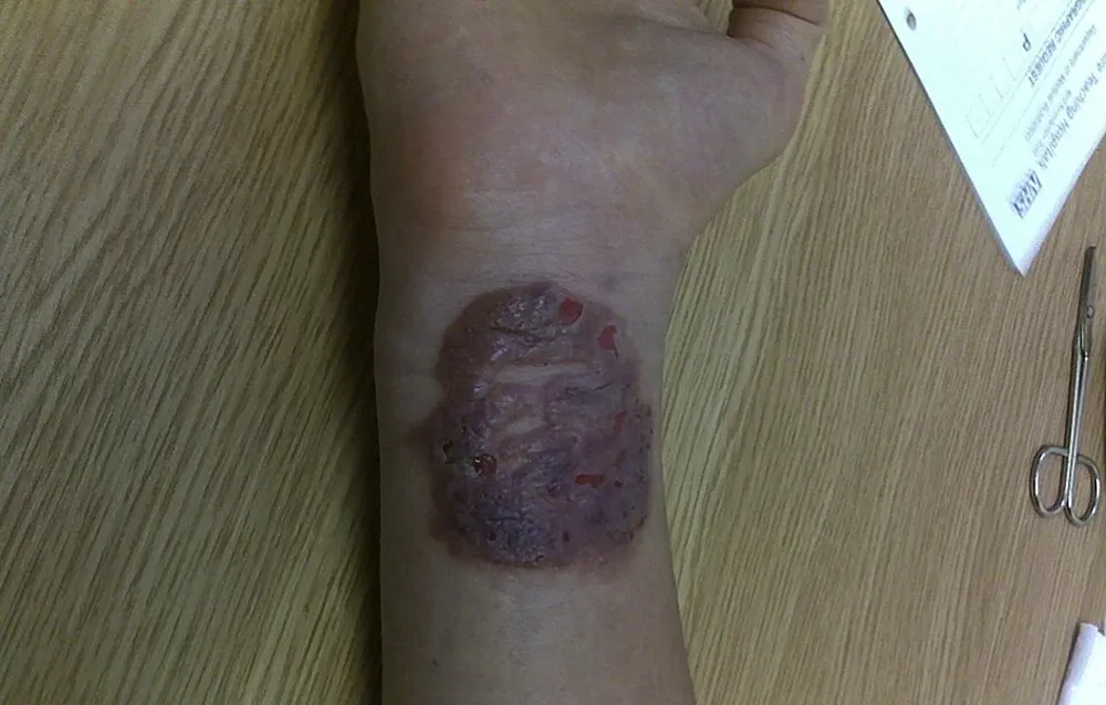 Resultado de tatuarse una imagen del Che Guevara con henna negra en el antebrazo