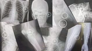 Radiografías de heridos de bala ingresados al hospital del Cerro