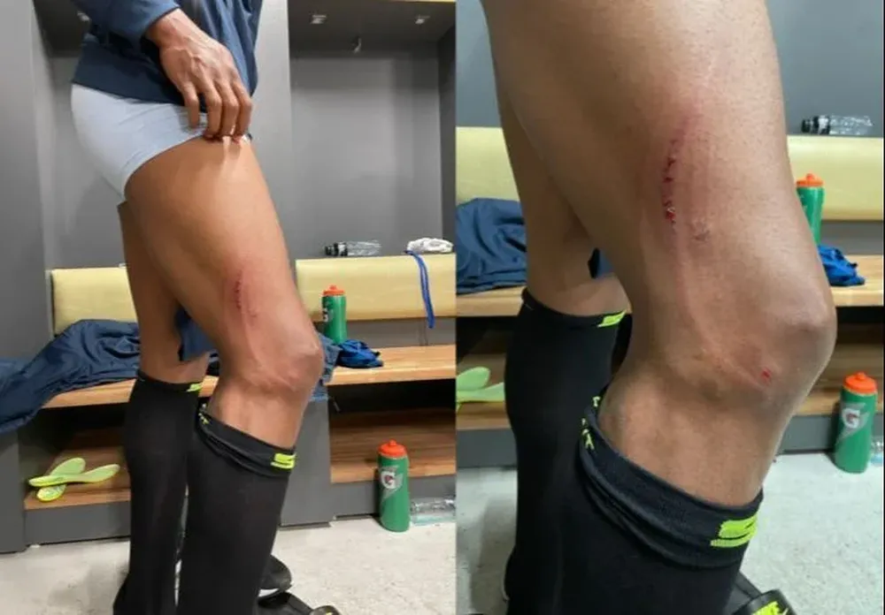 Así quedó la pierna de Estrada