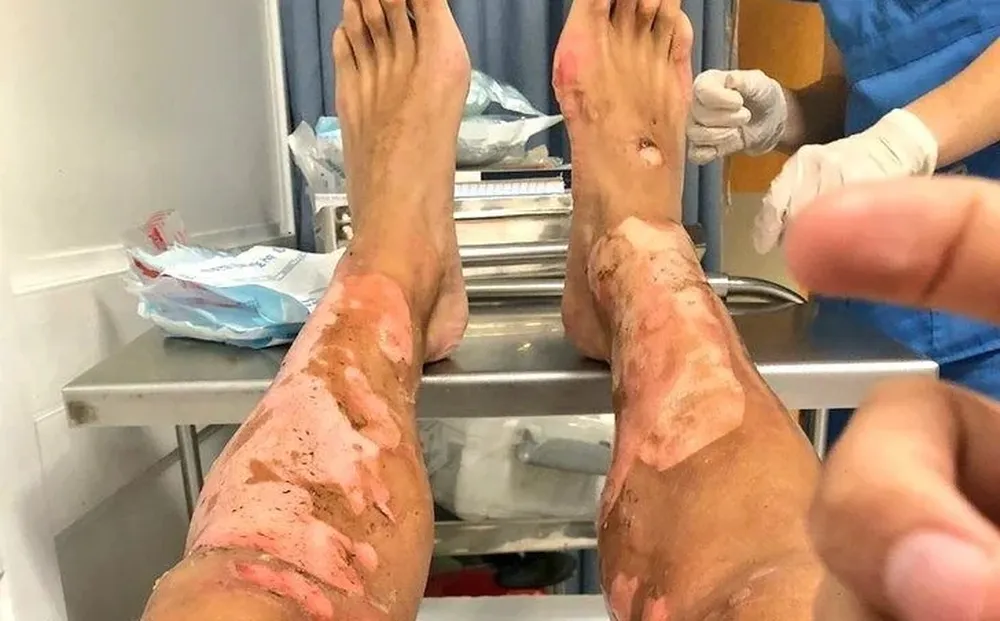 Así quedaron las piernas de Mathías Cardacio tras las quemaduras