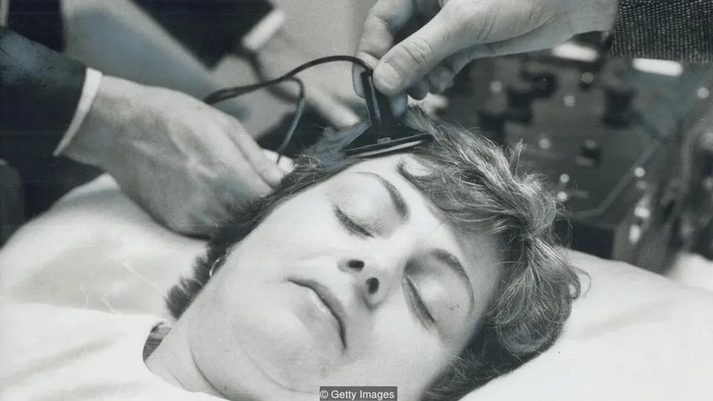 Doctores en un hospital de Toronto le colocaban electrodos a una persona en una sesión de TEC simulada en 1976.