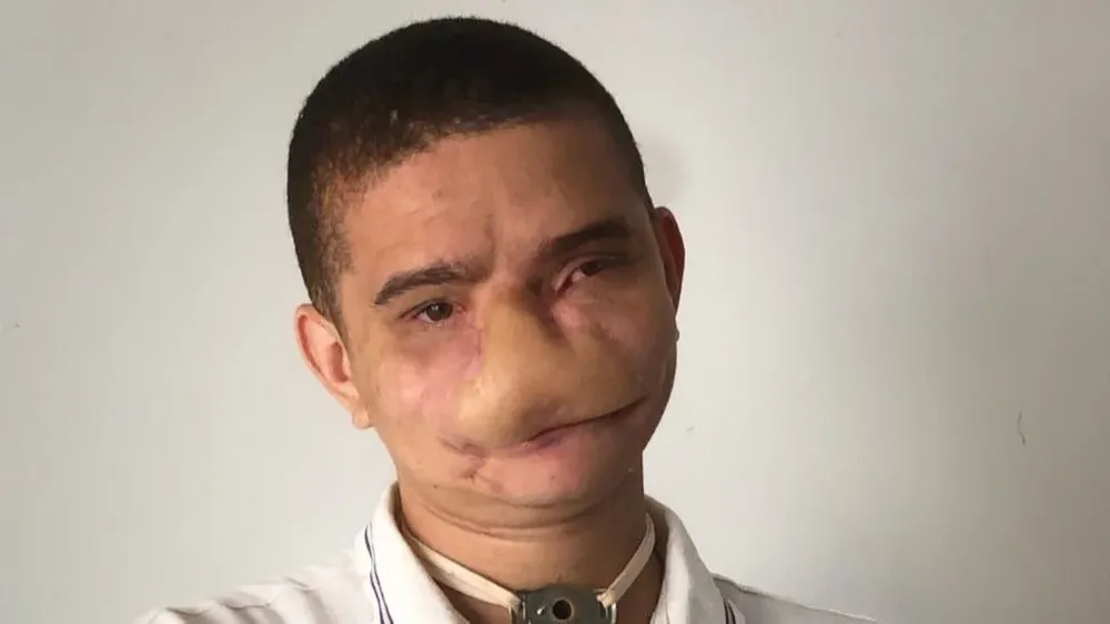 Samuel Rodrigues muestra las marcas dejadas por accidente; hoy respira por traqueotomía