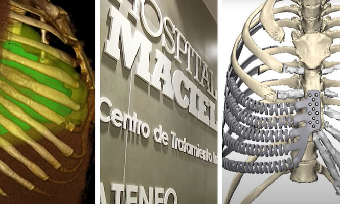 Inédita intervención torácica con prótesis 3D de titanio en el Hospital Maciel: un antes y un después en la salud pública uruguaya