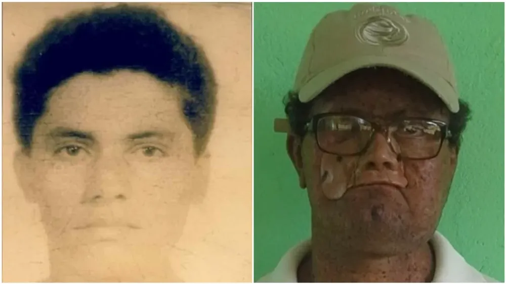 Deíde Freire de Andrade a los 18 años y ahora. Por culpa de esta extraña enfermedad perdió parte del rostro.