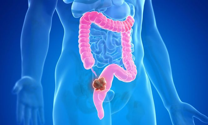 Uno de los síntomas del cáncer de colon es el cansancio extremo sin motivo.