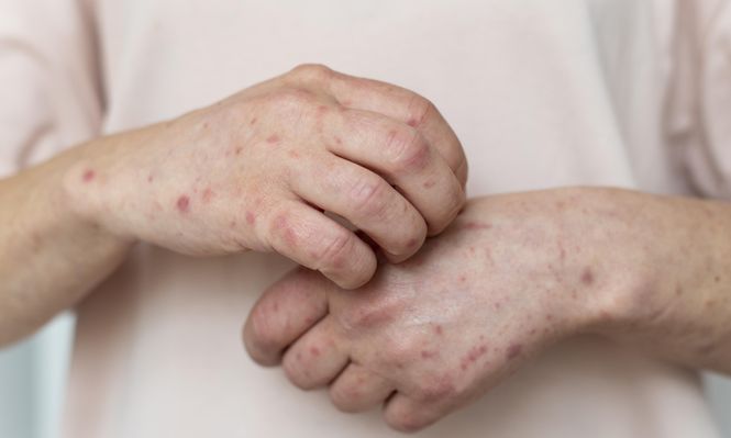 Sarampión en Uruguay: MSP refuerza campaña de vacunación y recuerda dónde y cuándo se pueden recibir las dosis